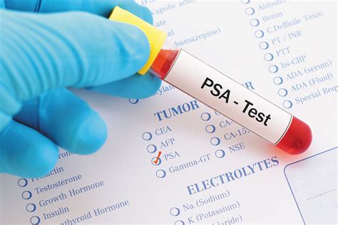 Dos and Don’ts Before a PSA Test 